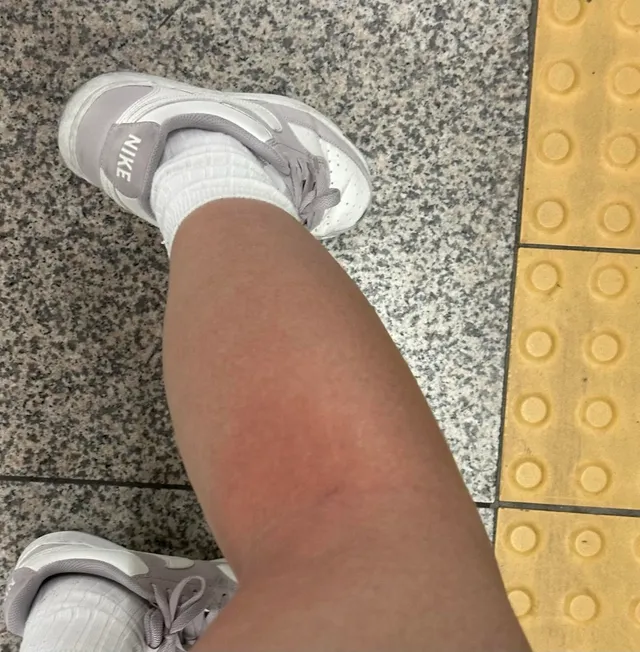 저 어제 13일 제일 더울때 1시부터 5시 좀 넘게까지 있다가 갔는데 이렇게 되었답니다! 양산쓰고 가서 얼굴은 괜찮은데 다리가ㅠㅠ 긴바지 입고 
